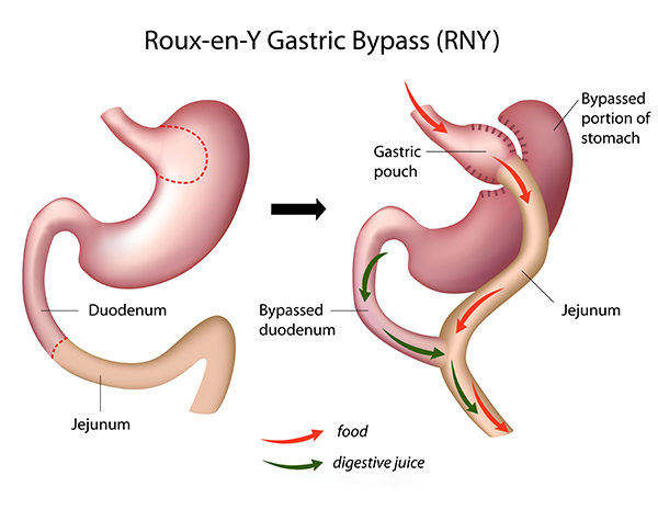 gastric-bypass