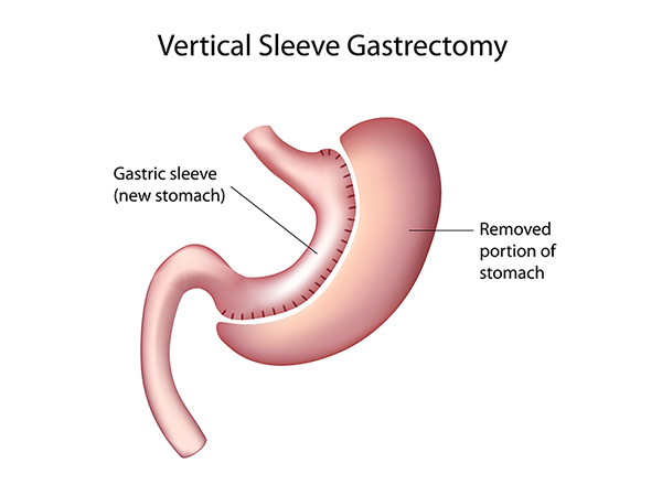 gastric-sleeve